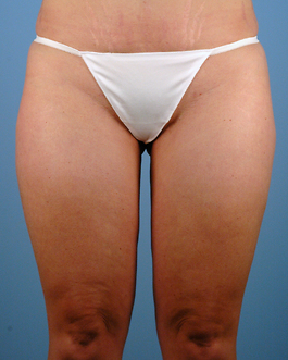 Liposuction Before and After | Dr. Thomas Hubbard