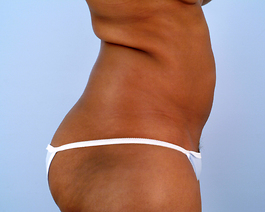 Liposuction Before and After | Dr. Thomas Hubbard