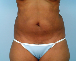 Liposuction Before and After | Dr. Thomas Hubbard