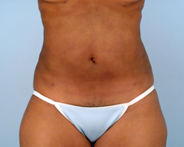 Liposuction Before and After | Dr. Thomas Hubbard