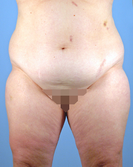 Liposuction Before and After | Dr. Thomas Hubbard