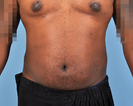 Liposuction Before and After | Dr. Thomas Hubbard