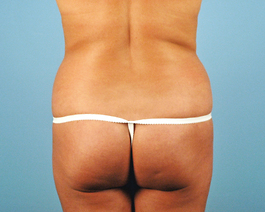 Liposuction Before and After | Dr. Thomas Hubbard