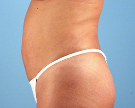 Liposuction Before and After | Dr. Thomas Hubbard