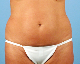 Liposuction Before and After | Dr. Thomas Hubbard