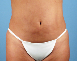 Liposuction Before and After | Dr. Thomas Hubbard