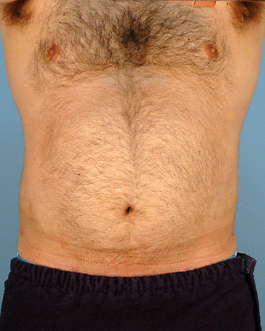 Liposuction Before and After | Dr. Thomas Hubbard