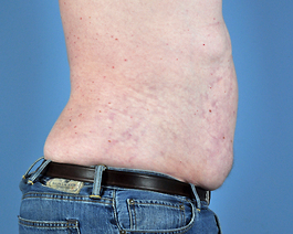 Liposuction Before and After | Dr. Thomas Hubbard