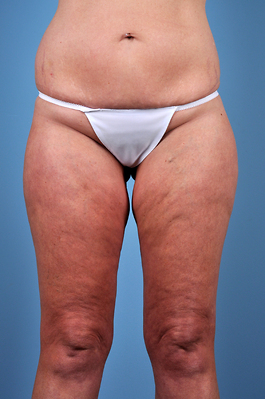 Liposuction Before and After | Dr. Thomas Hubbard