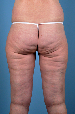 Liposuction Before and After | Dr. Thomas Hubbard