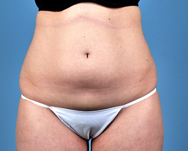 Liposuction Before and After | Dr. Thomas Hubbard