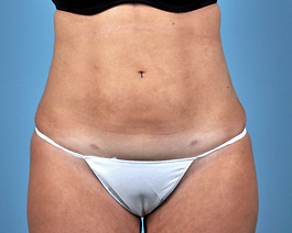 Liposuction Before and After | Dr. Thomas Hubbard