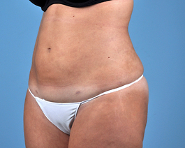 Liposuction Before and After | Dr. Thomas Hubbard