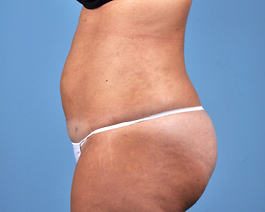 Liposuction Before and After | Dr. Thomas Hubbard