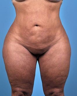 Liposuction Before and After | Dr. Thomas Hubbard