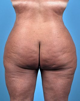 Liposuction Before and After | Dr. Thomas Hubbard