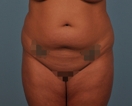 Liposuction Before and After | Dr. Thomas Hubbard