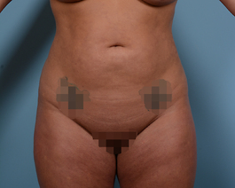 Liposuction Before and After | Dr. Thomas Hubbard