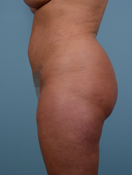 Liposuction Before and After | Dr. Thomas Hubbard