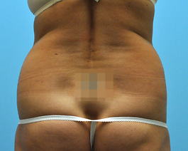 Liposuction Before and After | Dr. Thomas Hubbard