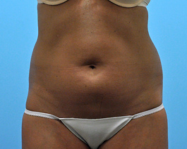 Liposuction Before and After | Dr. Thomas Hubbard