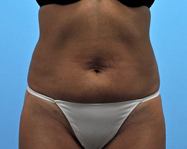 Liposuction Before and After | Dr. Thomas Hubbard