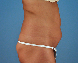 Liposuction Before and After | Dr. Thomas Hubbard