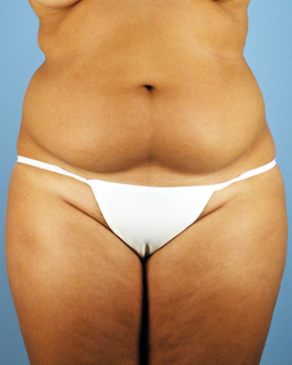 Liposuction Before and After | Dr. Thomas Hubbard