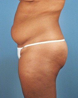 Liposuction Before and After | Dr. Thomas Hubbard