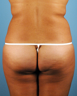 Liposuction Before and After | Dr. Thomas Hubbard