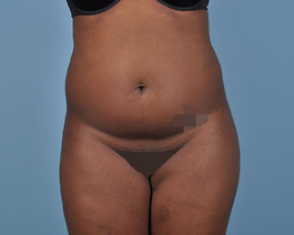 Liposuction Before and After | Dr. Thomas Hubbard