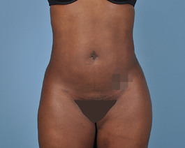 Liposuction Before and After | Dr. Thomas Hubbard