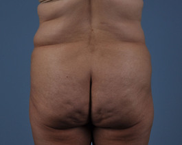 Liposuction Before and After | Dr. Thomas Hubbard