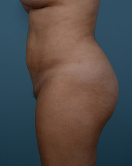 Liposuction Before and After | Dr. Thomas Hubbard