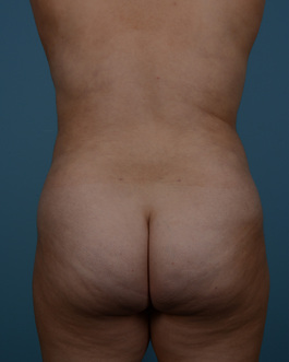 Liposuction Before and After | Dr. Thomas Hubbard