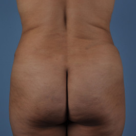 Liposuction Before and After | Dr. Thomas Hubbard