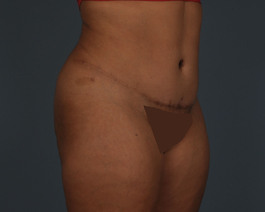 Liposuction Before and After | Dr. Thomas Hubbard