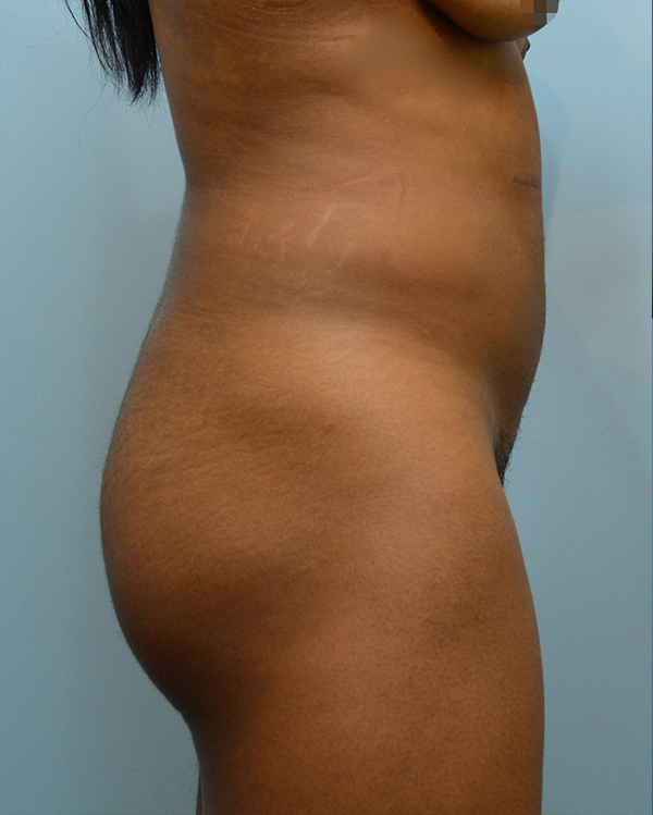 Liposuction Before and After | Dr. Thomas Hubbard