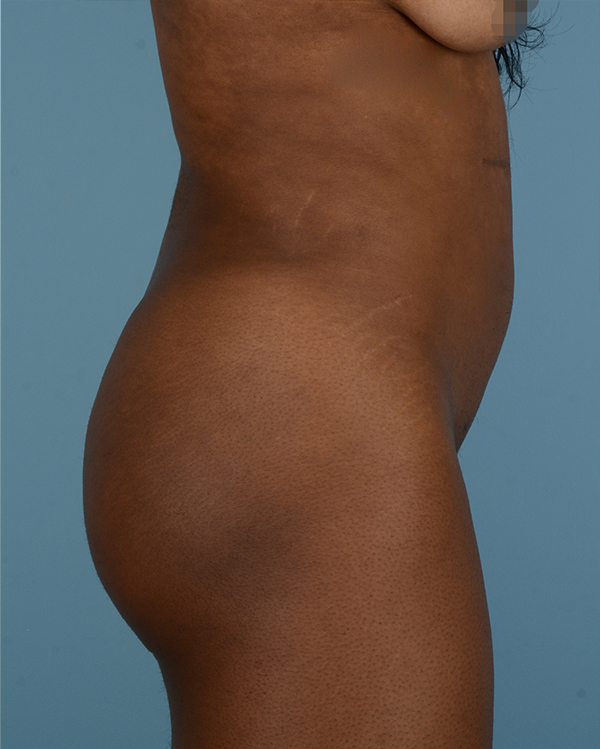 Liposuction Before and After | Dr. Thomas Hubbard