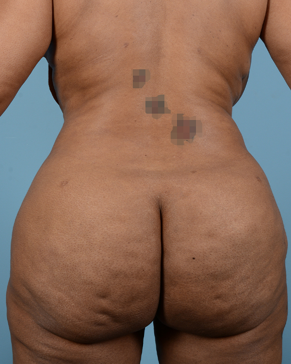 Liposuction Before and After | Dr. Thomas Hubbard