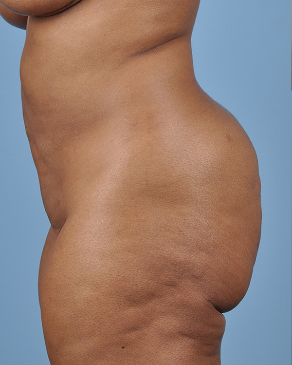 Liposuction Before and After | Dr. Thomas Hubbard