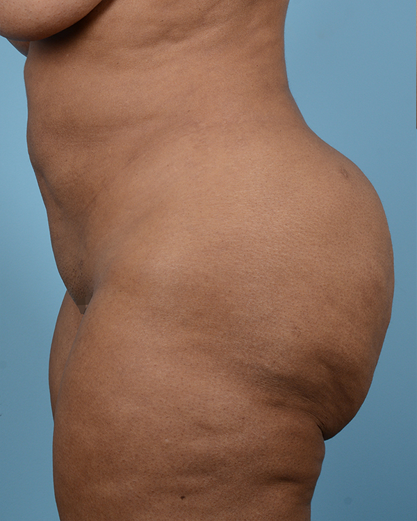 Liposuction Before and After | Dr. Thomas Hubbard