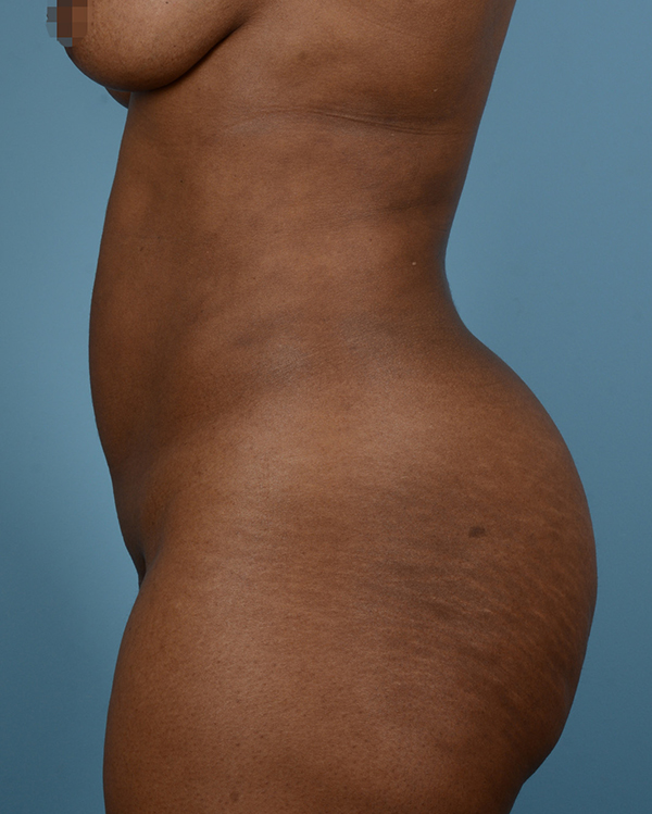 Liposuction Before and After | Dr. Thomas Hubbard