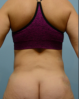 Liposuction Before and After | Dr. Thomas Hubbard