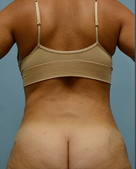 Liposuction Before and After | Dr. Thomas Hubbard