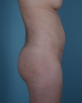 Liposuction Before and After | Dr. Thomas Hubbard