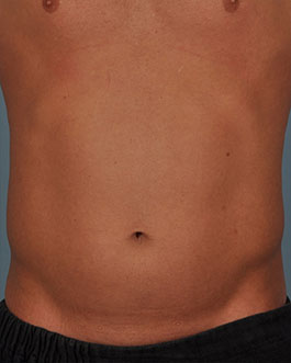 Liposuction Before and After | Dr. Thomas Hubbard