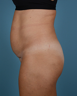 Liposuction Before and After | Dr. Thomas Hubbard