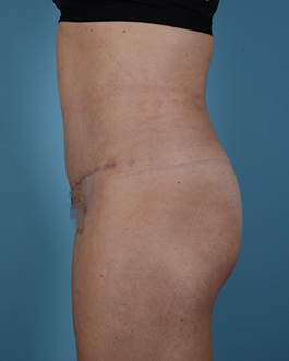 Liposuction Before and After | Dr. Thomas Hubbard