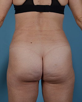 Liposuction Before and After | Dr. Thomas Hubbard